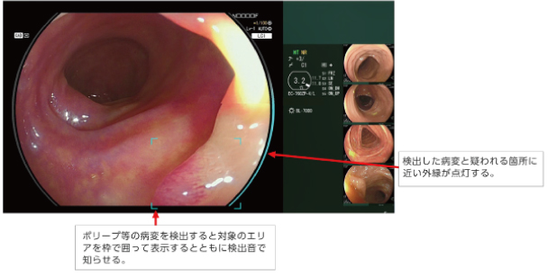CAD EYE の病変検出支援機能：検出した病変を枠で囲い、外縁が点灯する表示画面