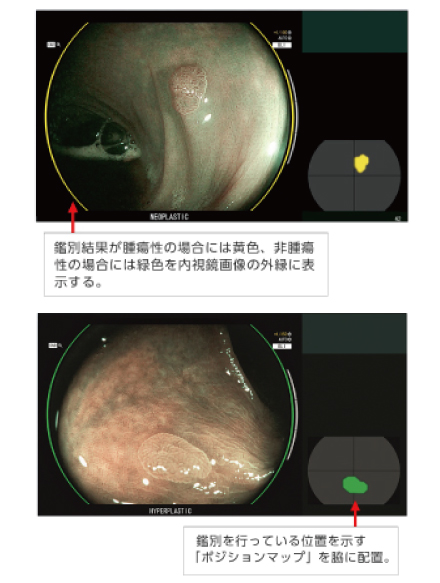 CAD EYE の疾患鑑別支援機能：腫瘍性は黄色・非腫瘍性は緑色で外縁とポジションマップに表示